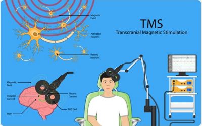Medical News: Transcranial Magnetic Stimulation Therapy for Depression